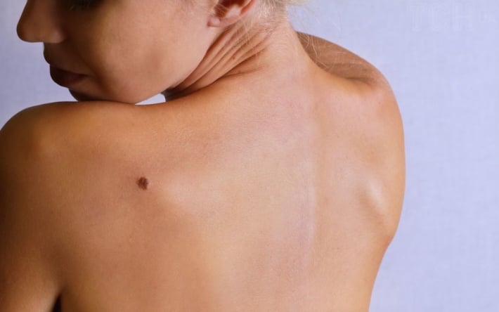 Меланома: врач-дерматовенеролог опровергла 5 опасных мифов