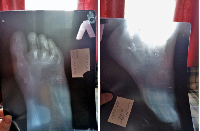 Білі цятки &ndash;&nbsp;це уламки - фото надала мама Юрія